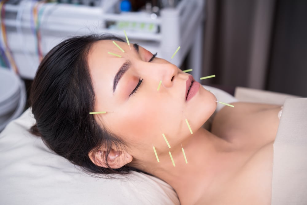 what is acupuncture