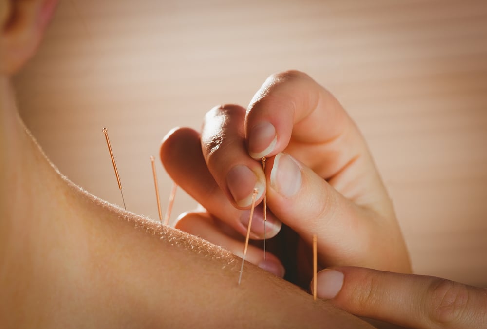 acupuncture for arthritis