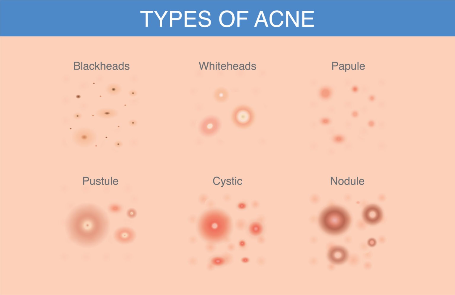 How To Get Rid Of Body Acne & Adult Acne? (+Types & Causes)